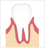 軽度歯周炎