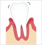歯周炎