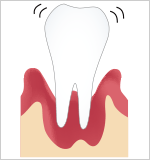 歯周炎